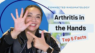 Arthritis in the Hands//Top 5 Facts to know when you have hand arthritis