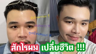 สักไรผม แก้ปัญหาหัวล้าน หน้าผากลึก !! | มะเดี่ยว มะใจ ชาแนล