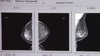 Here's why mammogram guidelines keep changing