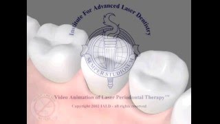 LANAP Protocol  - laser gum disease treatment