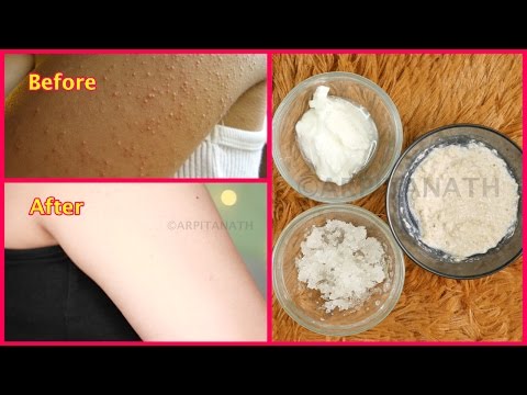 How to Get Rid of Tiny Red Bumps, Rashes from Face, Arms, Hips || Chicken Skin Treatment How to Get Rid of Tiny Red Bumps, Rashes from Face, Arms, Hips || Chicken Skin Treatment