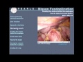 SAGES Pearls Session: Laparoscopic Nissen Fundoplication - Technique Video