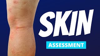 Skin Focused Nursing Assessment | The Most Common Findings!