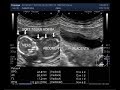 Ultrasound Video showing Fetal demise with soft tissue edeme around the head and abdomen.