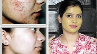 Remove PIMPLES,ACNE,DARK SPOT instantly with multani mitti face pack in summer||TipsToTop By Shalini