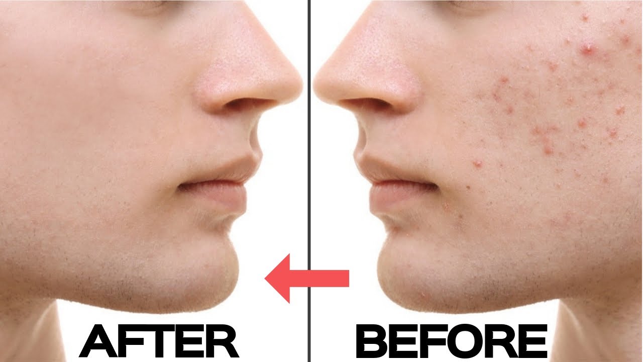 How To Avoid Pimples On The Face - Braincycle1