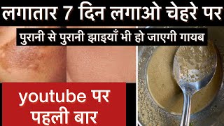 Jhaiyo ko kaise sahi karein / jhaiyo me fark dekhe 7 deen me ||#pigmentation