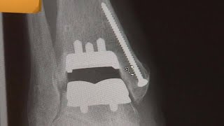 Ankle replacement option for patients with age, injury-related problems