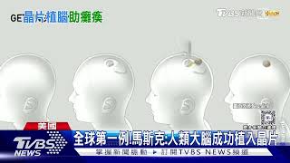 全球首例!馬斯克X平台宣布 人類大腦成功植入晶片｜TVBS新聞