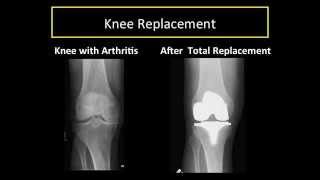 Understanding Knee Arthritis, Partial and Total Knee Replacement