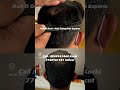 10 മാസം കൊണ്ട് ഇത്രയും മാറ്റം😲 drsreenath hairtransplant hairtransplantkerala