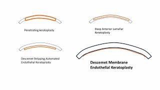 Corneal Transplant : PKP, DALK, DSEK, and DMEK