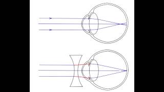 Refractive Errors - Hyperopia, Myopia, Astigmatism, Accommodation & Presbyopia Refractive Errors - Hyperopia, Myopia, Astigmatism, Accommodation & Presbyopia