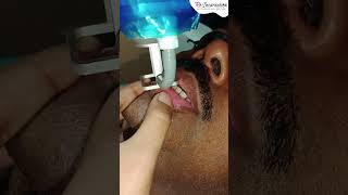 Fractional CO2 Laser for Vitiligo | Dr. Priyanka Agarwal