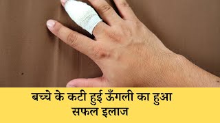 कटी हुई ऊँगली का हुआ सफल इलाज | Finger Cut Injury Treatment