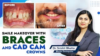 Smile Makeover with BRACES and CAD CAM crowns: Dr. Srishti Bhatia #smile #smilemakeover