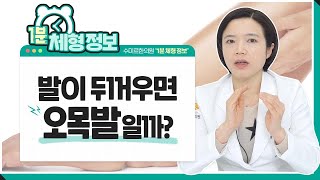 [1분체형정보] 두꺼운 발? 발이 두꺼우면 오목발일까?