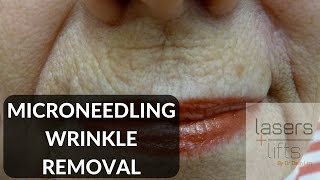 Microneedling for skin rejuvenation