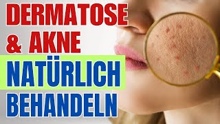 Schluss mit Chemie: So behandelst du Akne auf natürliche Art!