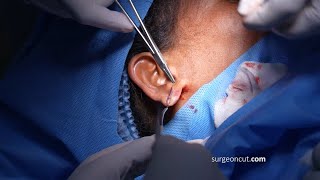 Live Earlobe Surgery Procedure | Earlobe Surgery In India