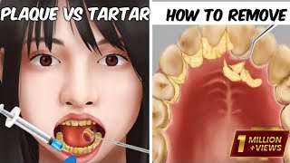 [ASMR] tartar removal animation /Remove botfly maggots found inside mountaineer mouth | Dental care