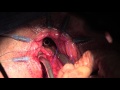 dr. karen zaghiyan performs transanal total mesorectal excision