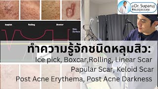 ทำความรู้จักชนิดของหลุมสิว: Ice pick, Boxcar,Rolling, Papular Scar, Keloid Scar, Linear Scar …