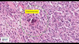 Meningioma (meningothelial) microscopy - Talking slide