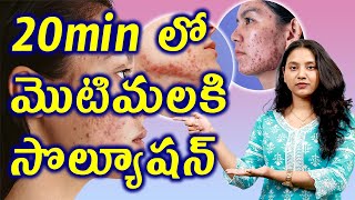 20 min లో మొటిమలకి సొల్యూషన్ Best Solution for ACNE or Pimples in 2 Mins | డా. భరద్వాజ్ | హోమియోపతి