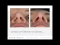 The interface of form and function in tip rhinoplasty