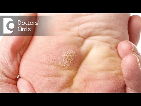 What causes warts on hands and feet?