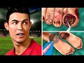 ASMR Treatment for Ronaldo: Help Ronaldo Cure Ingrown Nail Due to Bad Soccer Shoes | Ronaldo Youtube