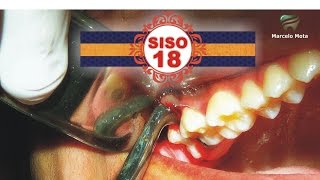 EXTRAÇÃO DE SISO 18 / wisdom tooth Extraction Surgery