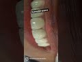 6 porcelain veneers in 2 weeks by cosmetic dentist Dr Trivikram.