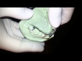 Orthodontics with a Partial Denture