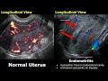 uterus u0026 adnexa ultrasound normal vs pelvic inflammatory disease pid images gynecological usg