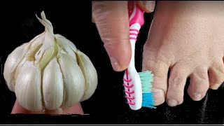 Instantly removes nail fungus like an eraser! The best natural remedy! 100 efficiency. İncredible