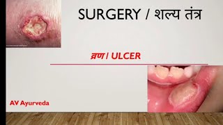 ULCER/VRAN/व्रण/शल्य तंत्र/Surgery /BAMS lecture of 4th year