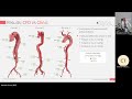 cfd for personalised vascular interventions vanessa diaz