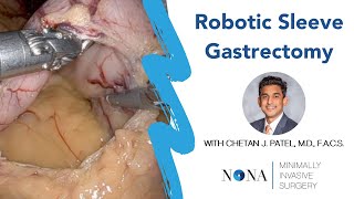 Robotic Sleeve Gastrectomy