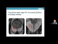 mri invisible lesions and low risk prostate cancer