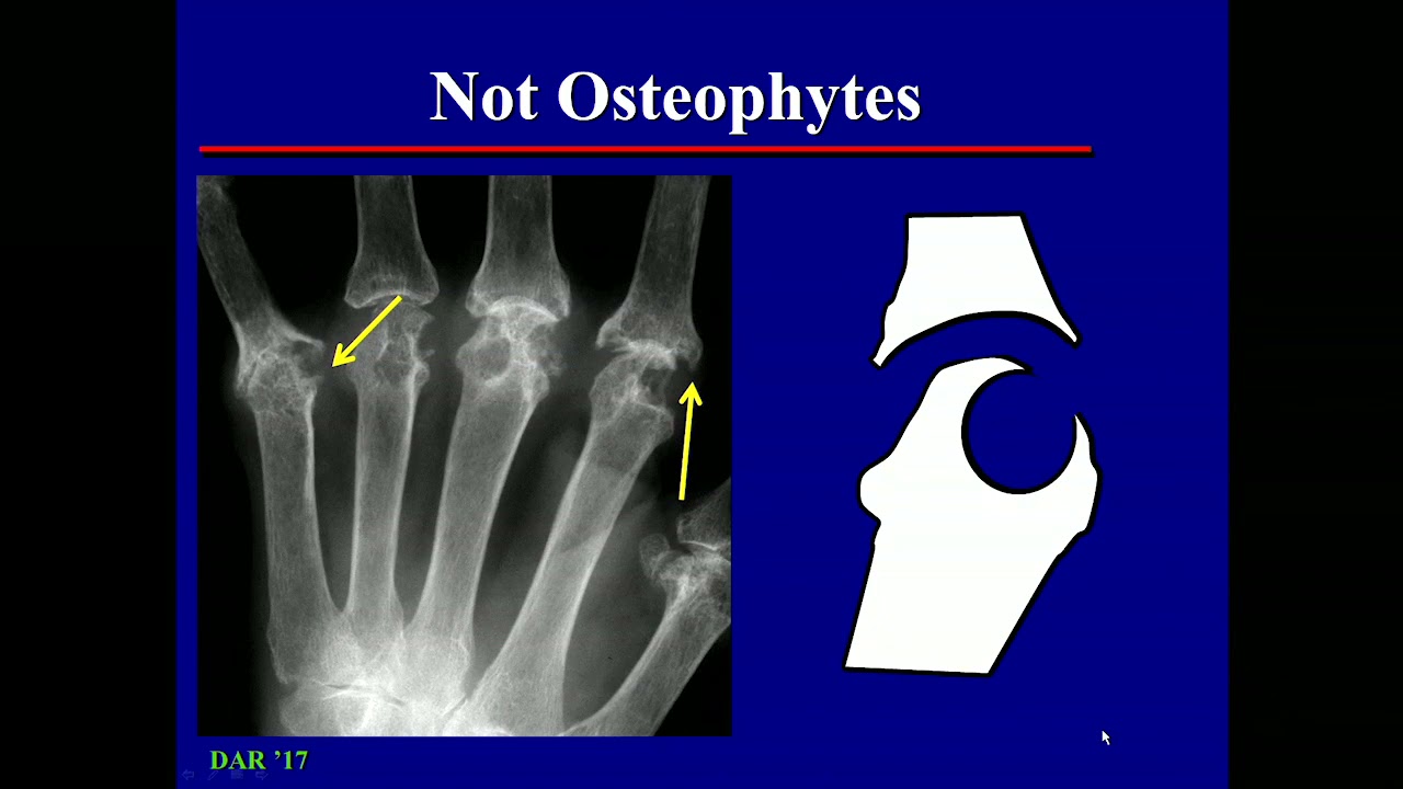 Imaging In Osteoarthritis - YouTube