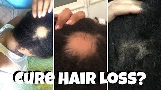 How to Cure Hair Loss