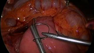 Superior Mesenteric Artery Syndrome Following Gastric Bypass