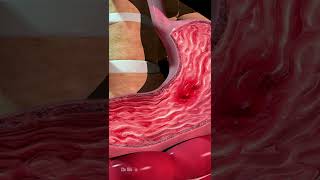 What Can Cause Stomach Ulcers (Animation)