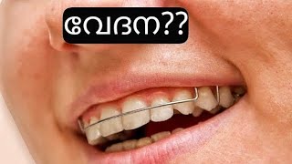 Retainer ഇടുമ്പോൾ വേദന? pallil kambi idunnath malayalam / pallil kambi idunnath /braces /ottakambi