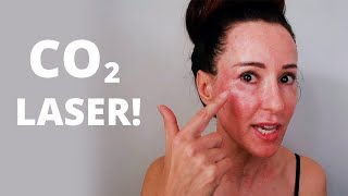 CO2 Fractional Ablative Laser: Before & After, Pain Levels, & Recovery! | Dr. Bartos Dermatology