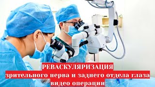 Реваскуляризация зрительного нерва и заднего полюса глаза 👀 - видео операции