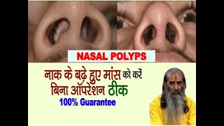 नाक के बढ़े हुए मांस (Nasal Polyps) का बिना ऑपरेशन इलाज संभव || Naak me Maas Badhne ka ilaaj jaane||