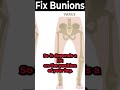 What Causes Bunions on Feet FOR REAL? [What are Bunions? REALLY?]